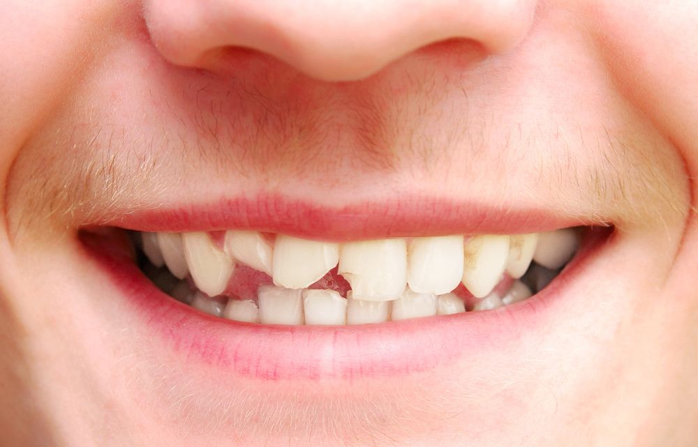 Giải Mã Giấc Mơ Thấy Gãy Răng? Đánh Số Gì Khi Mơ Thấy Gãy Răng